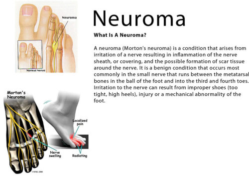 I have been diagnosed with a Neuroma…