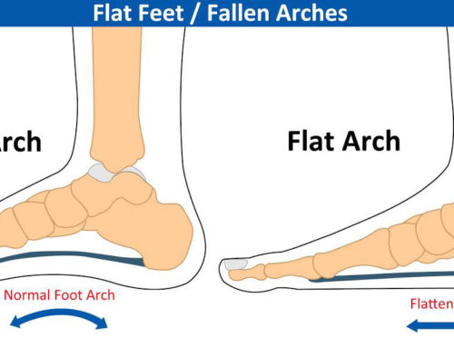 Arch Support for Flat Feet