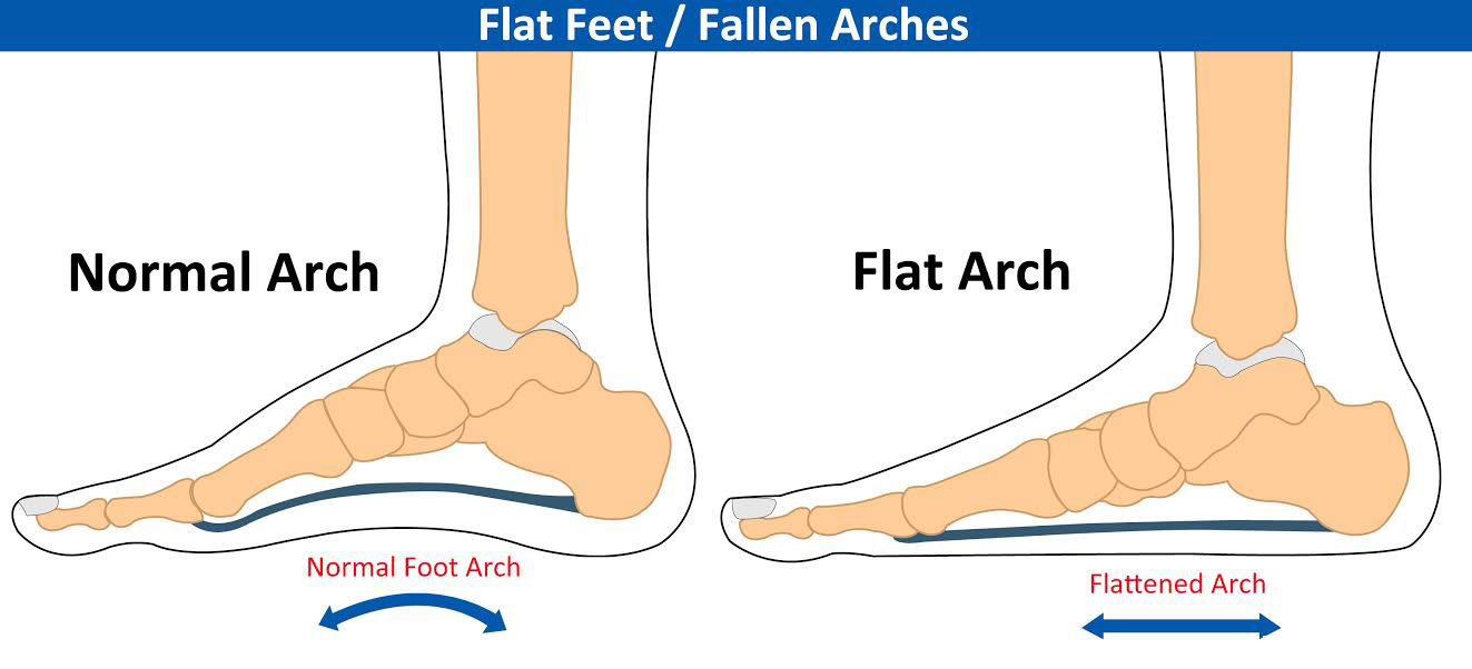 arch supports for feet